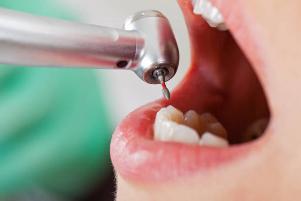 Best Emergency Treatment for Dental Infections or Abscesses in Matteson, IL